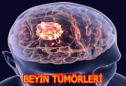 beyin-tumor
