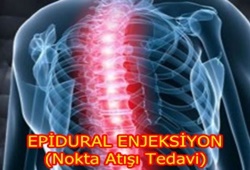 epidural